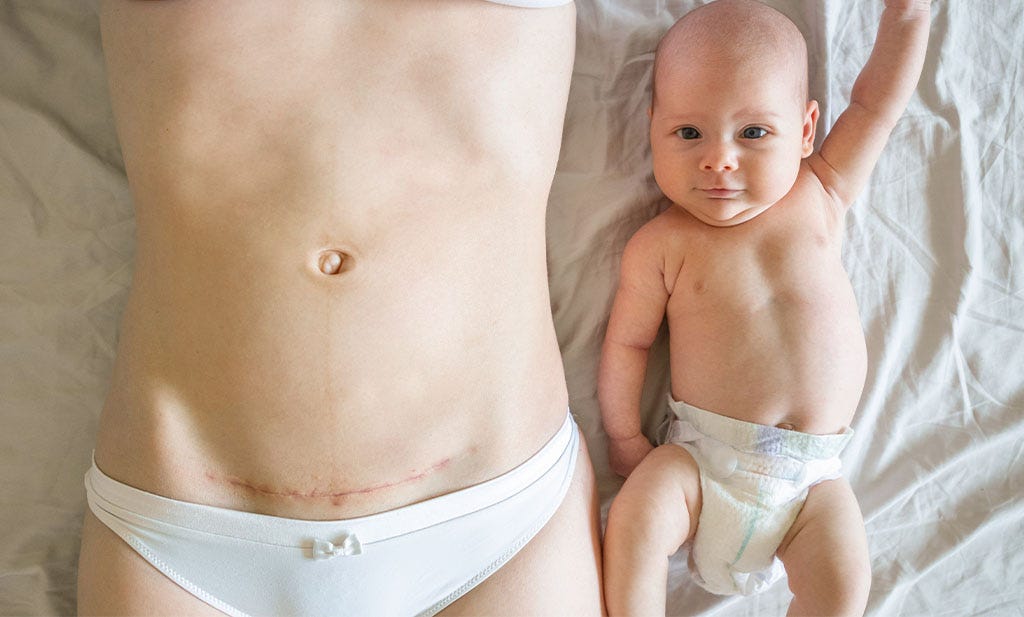 Vaginal birth or c-section?